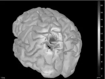 Fig. 3.  Localization Results for a single source, using wMNE, for EEG.  