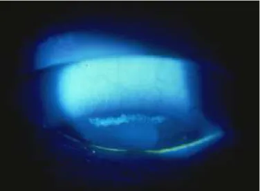 Figura  3.1.1  –  Imagem  de lesão  epitelial  arqueada  superior  vista  com  filtro  azul-cobalto  após  instilação  de  fluoresceína