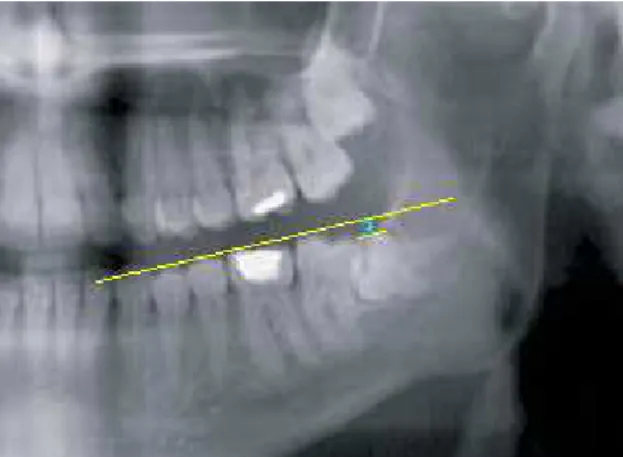 Figure 3. The space between M3 crown and the  occlusal plane 
