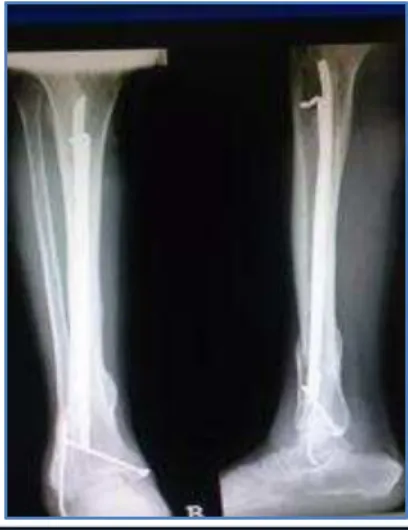 Fig. 1: Preoperative X –ray with implants in situ 