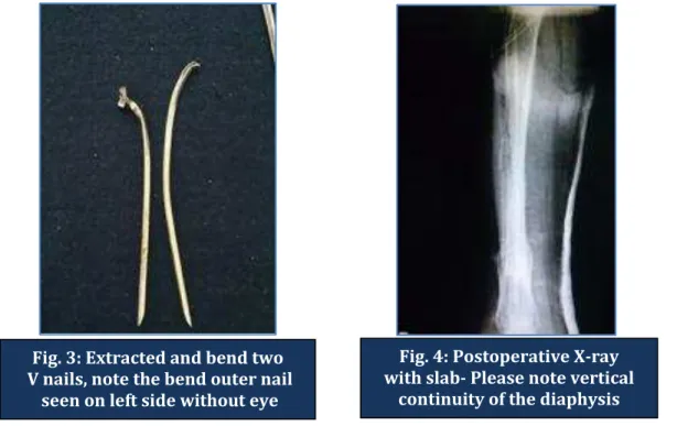 Fig. 3: Extracted and bend two   V nails, note the bend outer nail 