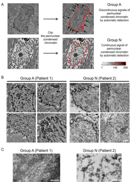 Fig 1. Classification of Groups A and N Based on Quantitative Analysis. (A) Representative original electron microscopic images before digital analysis are shown (10,000× magnification)
