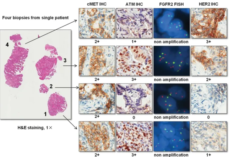 Fig 1. Pathological assessment of biomarker status on each individual biopsy. This is an example case which shows the individual score given to each biopsy for each biomarker