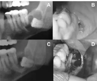 Figura 1.   A) Detalhe em radiograia panorâmica; B) Aspecto clínico 7 dias após  marsupialização;  C)  Radiograia  panorâmica  4  meses  após  marsupialização; D) Exodontia do dente 38 e curetagem da lesão.