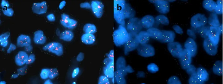 Fig 1. FISH analysis on EGFR gene amplification in MBC. Representative images of amplification of EGFR (a) and high aneusomy of EGFR (b)