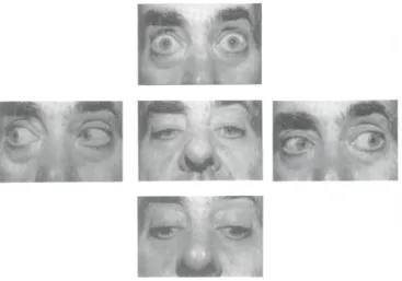 Figura 1: Imagem representativa da sequência de movimentos oculares, ilustrando a limitação completa  do olhar vertical para cima e parcial do olhar lateral e a integridade do olhar vertical para baixo [23] 