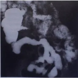 Figura 1  [21]  - Radiografia contrastada com bário do intestino delgado num doente com DC