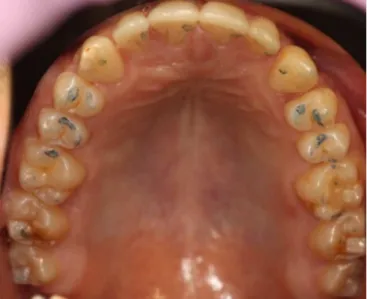 Fig. 3. Occlusal contacts of the upper jaw– two-stage registration