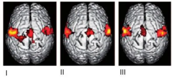 Figura  2  -  Reorganização  do  córtex  somatossensorial  primário  e  motor  em  pacientes  que  fizeram  amputação de um braço com DF (I) e sem DF (II), e um controlo saudável (III)