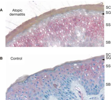 Figure 4. Immunohistochemical Analysis of Collagen XXIX Expression in AD Skin