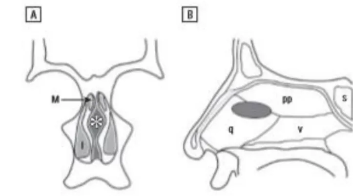 Ilustração 4 - A, Diagrama coronal do corpo cavernoso septal (*)  mostra  a  sua  localização  anterior  ao  corneto  médio  (M)  e  superior  ao  corneto  inferior  (I)