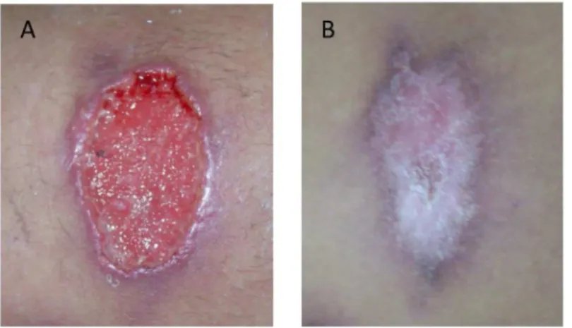 Fig 1. Skin lesion caused by Leishmania (Viannia) braziliensis and coinfected with Streptococcus pneumoniae