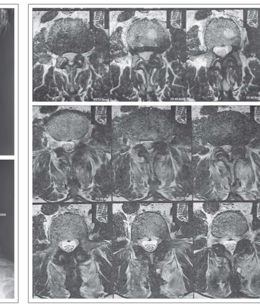 Abbildung 4:  Funktionsröntgen nach 6 Monaten zeigt