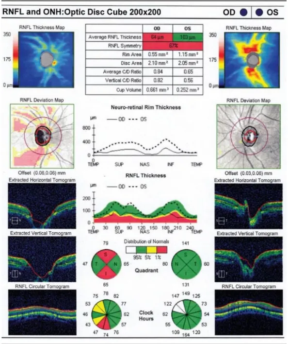 Figura 16: Avaliação do D.O e CFN com glaucoma no OD vs sem glaucoma no OE.