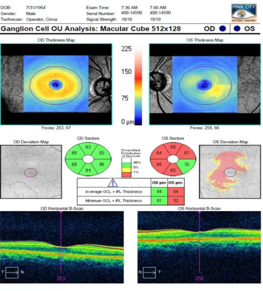 Figura 17: Avaliação da zona macular com glaucoma no OE vs sem glaucoma no OD. 
