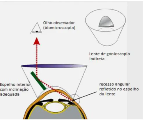 Figura 24: Goniotomia. 