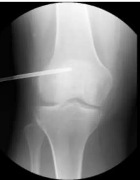 Figura 3.1 – Biopsia de osteossarcoma do fémur distal guiada por radioscopia. 