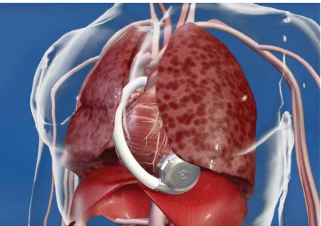 Fig. 6 – HVAD position inside the chest (with permission from Heartware Inc.).
