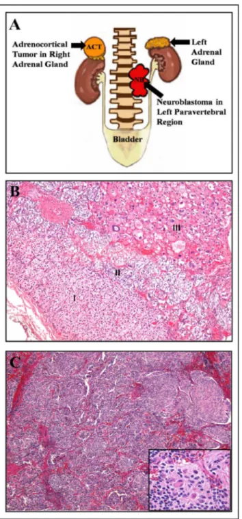 Fig 1. Morphological and histological characterization of tumors from patient #1, presenting concomitant NB and ACT