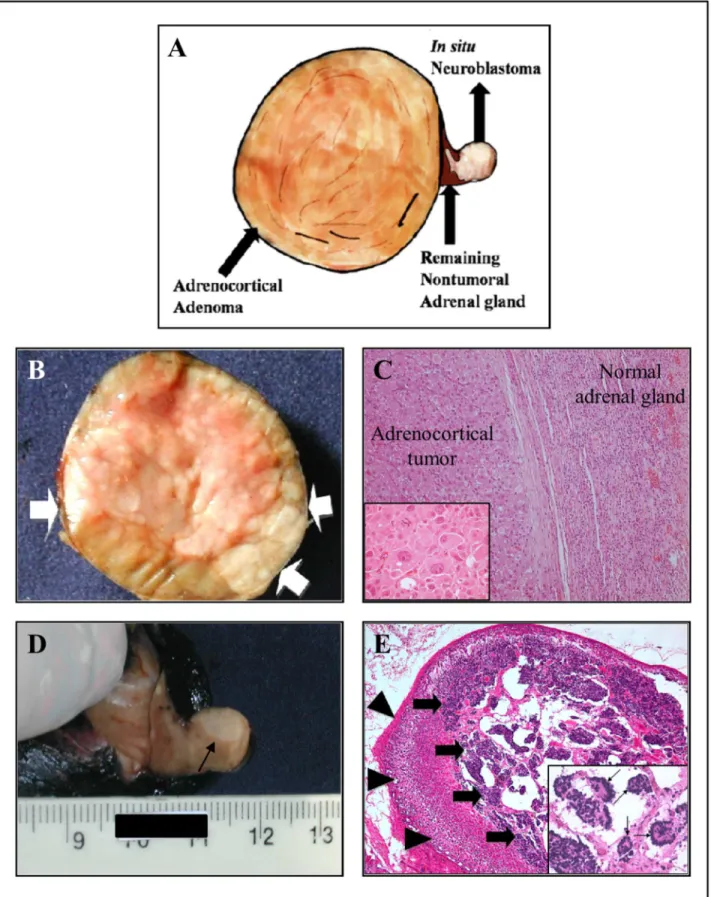 Fig 2. Morphological and histological characterization of tumors from patient #2, presenting concomitant NB and ACT