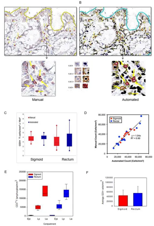 Fig 2. Application of an automated algorithm to quantitate T lymphocytes in immunostained sigmoid colonic and rectal mucosa