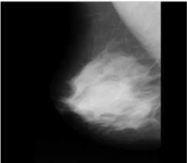 Fig 1: Example of a mammogram 