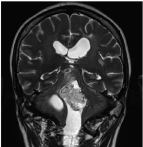 Figura 1. Hemangioblastoma   no IV ventrículo - corte coronal.