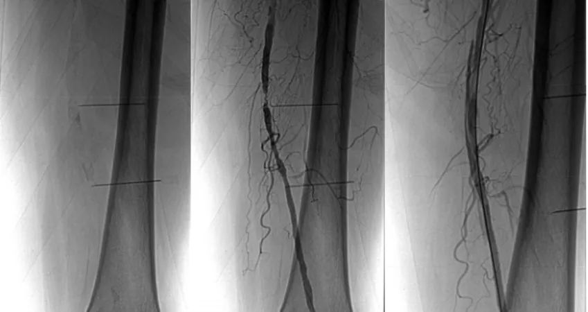 Fig. 2 − Calcified, occlusive, dissection lession after percutaneous transluminal angioplasty (healed with stent implantation)