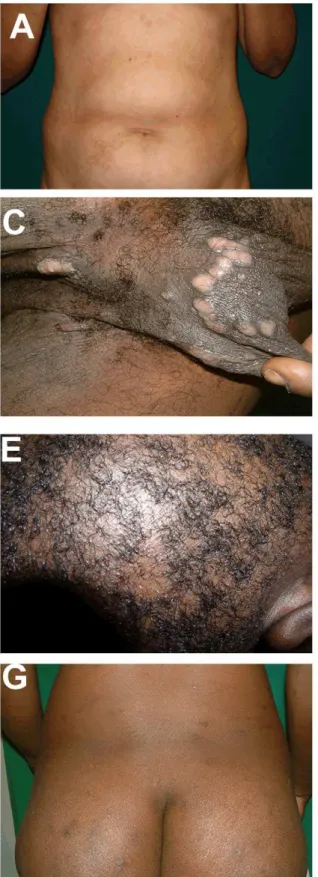 Figure 3. Mucosal and cutaneous lesions of secondary syphilis. Secondary syphilis has been known as the ‘‘Great Imitator’’ due to the diversity of dermatologic lesions and which can be confounded with other cutaneous diseases