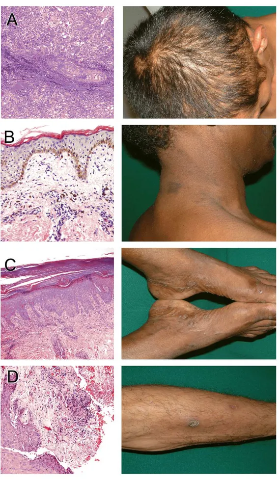 Figure 4. Secondary syphilis histopathology. The figure shows histopathologic anomalies seen in punch biopsies obtained from four secondary syphilis patients skin lesions