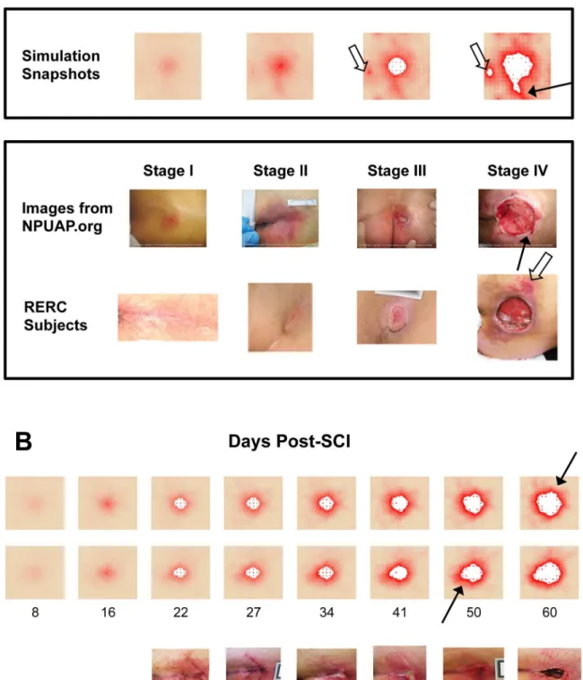 Fig 3. Simulations of the PUABM match key features of clinical images. (A) Simulations achieved visual appearances with characteristics similar to each stage of PU development