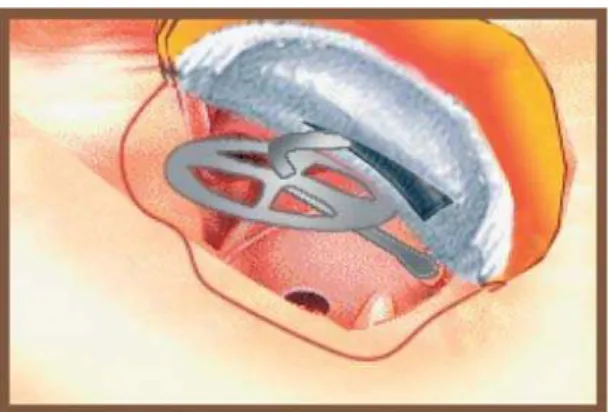 Fig. 8 – A prosthesis in the place (intraoperatively).