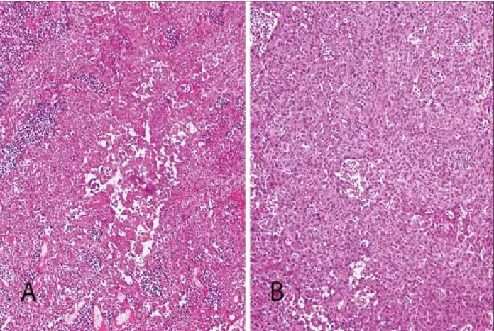 Figure 1. A) Acantholytic squamous cell carcinoma with pseudoglandular spaces and acantholytic cells (HE staining, 100×)