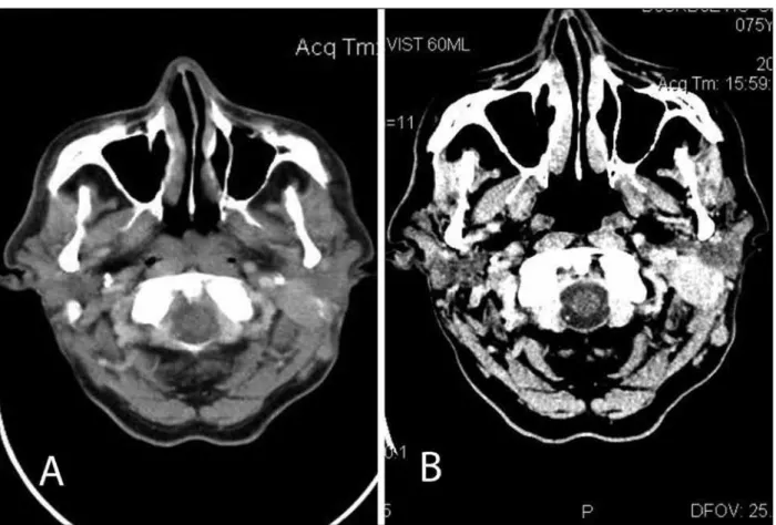 Figure 2. Multislice computed tomography (MSCT) of the head without contrast (A) and with contrast (B) showed an infiltrative mass in the  retroauricular and parotid region on the left side, with destruction of the mastoid processus.