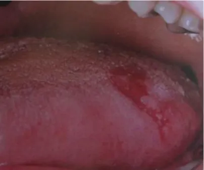 Fig. 3.2 – Eritroplasia da porção dorso-lateral da língua (Adaptado de 20) 