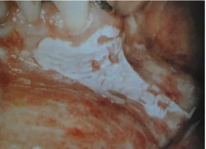 Fig. 3.3 – Leucoplasia do rebordo alveolar e mucosa do lábio (Adaptado de 20) 