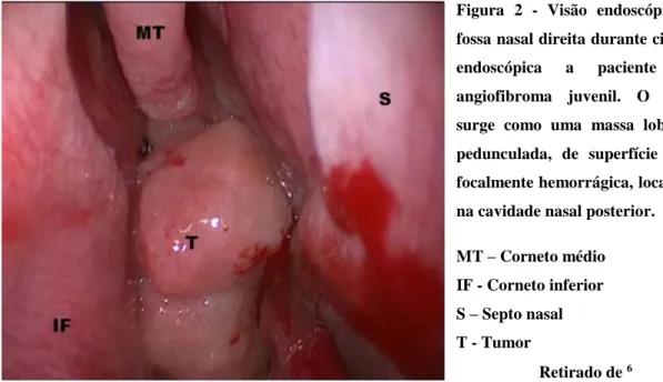 Figura  2  -  Visão  endoscópica  da  fossa nasal direita durante cirurgia  endoscópica  a  paciente  com  angiofibroma  juvenil