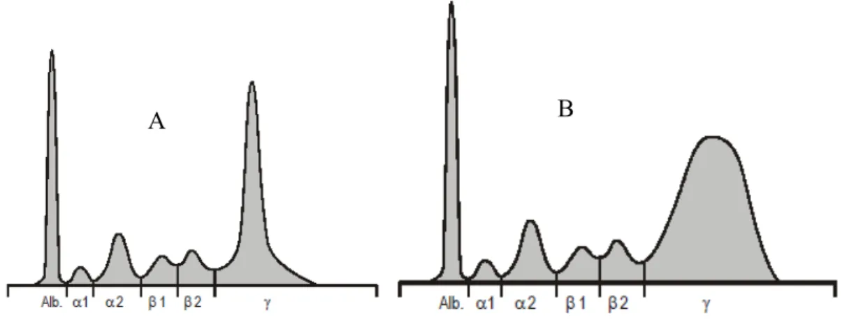 Figura  4  -  Perfil  electroforético  de  proteínas  totais  séricas,  evidenciando  os  picos  monoclonal (A) e policlonal (B) nas frações correspondentes às γ-globulinas