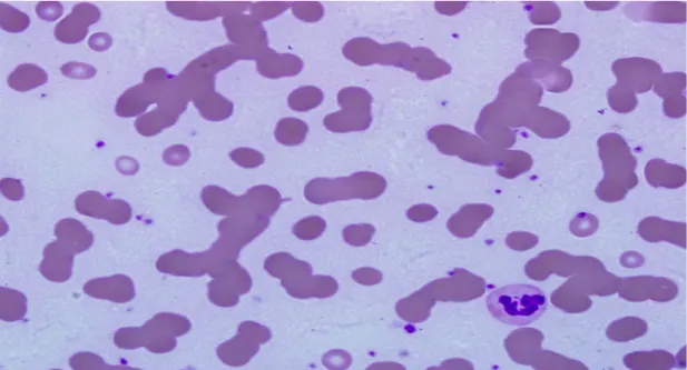 Figura  8  –  Formação  de  “rouleaux”  de  glóbulos  vermelhos  em  sangue  periférico  de  doentes com mieloma múltiplo
