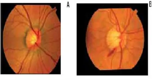 Figura  1.Nervo  óptico.  A  -  Nervo óptico  normal.  B-Nervo  óptico  com  glaucoma  primário de ângulo aberto (GPAA).Adaptado de (Betinjane, Silva et al., 2005) 