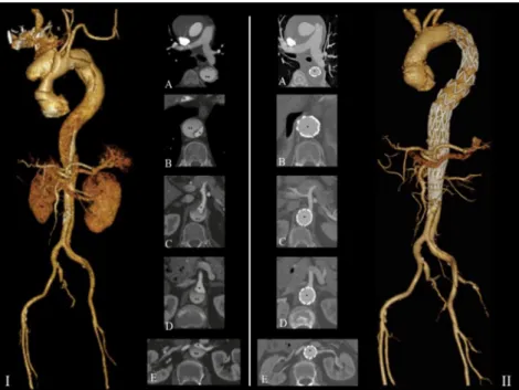 Figure 1. I. Pre-operative computed tomography angiography of a “ subacute ” type A aortic dissection