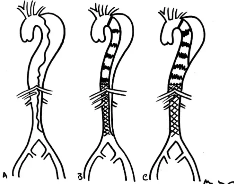 Figure 3. Schematic representation of the STABILISE technique. (A) Type B aortic dissection