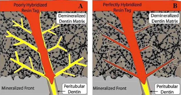 Figura 1. Esquema da micropermeabilidade dentinária sem etanol (A) e com etanol (B) (Pashley et al., 2011)
