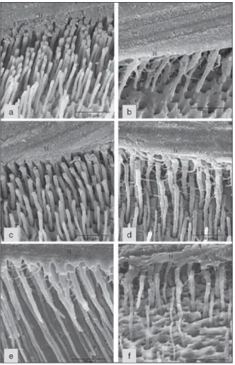 Figura 3. Imagens de SEM da interface da dentina radicular. Do lado esquerdo, (a), (c) e (e) referem-se aos adesivos  aplicados com a EWBT
