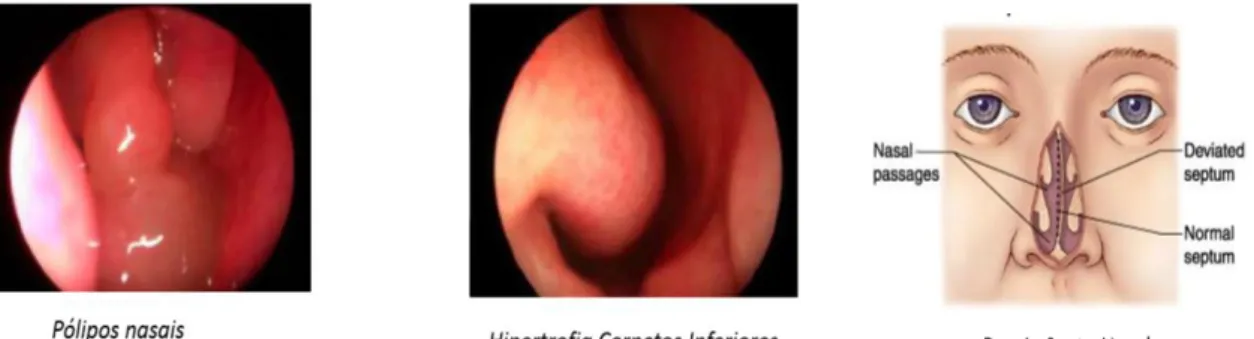 Figura 4. Causas de obstrução nasal 