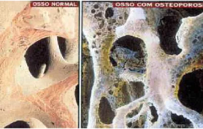 Figura 1- Osso normal / osteoporose  Fonte:&lt;http://www.lincx.com.br/lincx/sau de_a_z/prevencao/des_osteoporose.asp&gt; 