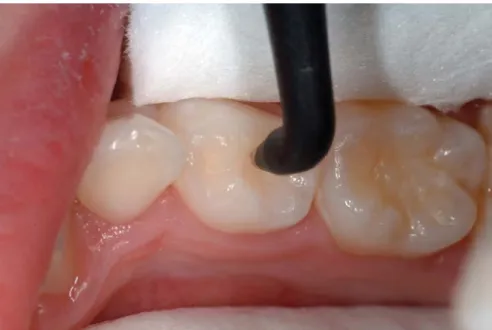 Figure 1. Use of the fluorescent laser device on the occlusal surface of a primary first molar.