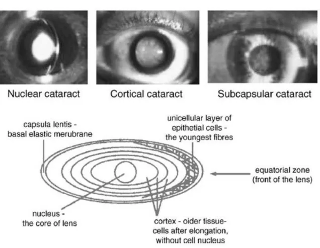 Figura 3. Ilustrações da anatomia do cristalino e dos tres  tipos de catarata, adaptado de  OTTER et al., (2010)