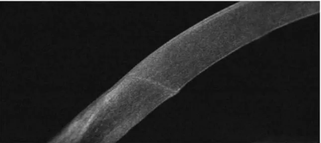 Figure 1.  FD-OCT after cataract extraction showing the corneal incision.   