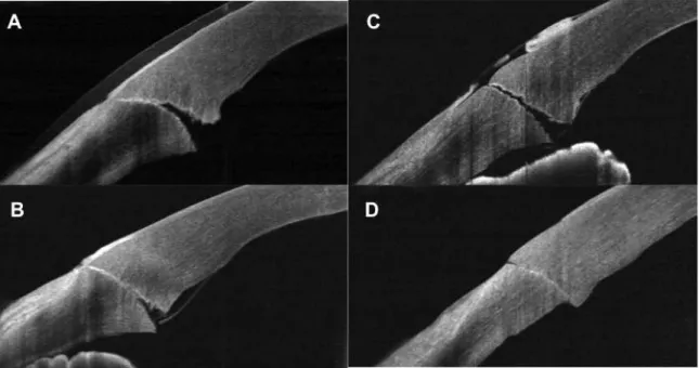 Figure 2.  Complications of corneal incision after cataract surgery observed with FD- FD-OCT imaging